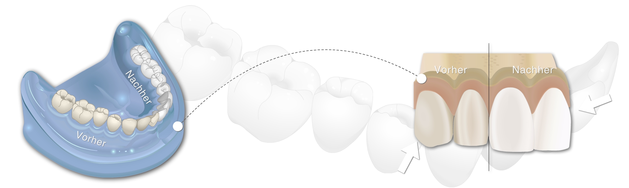 Darstellung einer Zahnaufhellung wo man Vorher und Nachher sieht an einem Modell sowie Frontansicht einer Zahnreihe