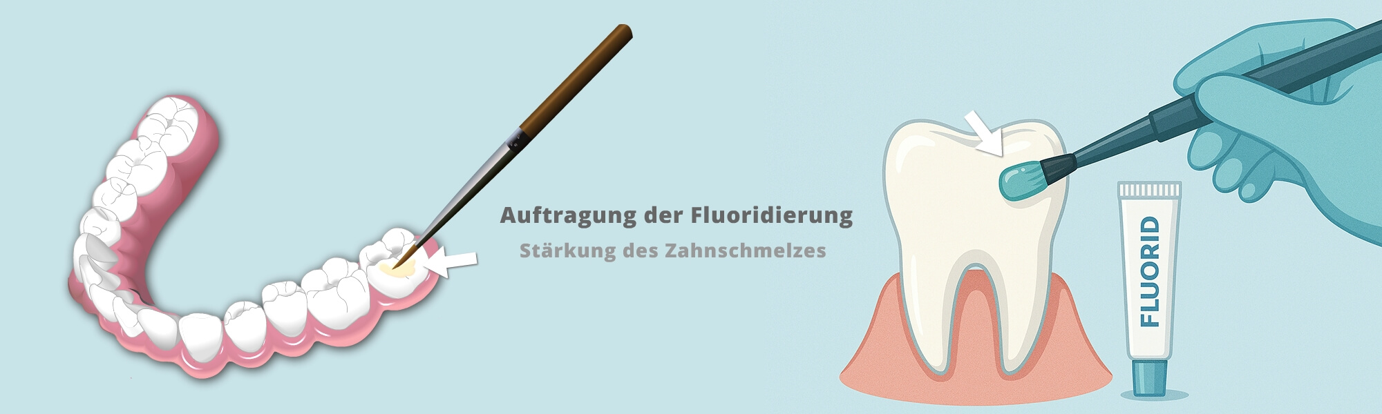 Man sieht eine Behandlung mit Fluorid, die den Zahnschmelz stärkt, das Kariesrisiko reduziert und zu langfristig gesunden Zähnen bei Kindern und Erwachsenen beiträgt.