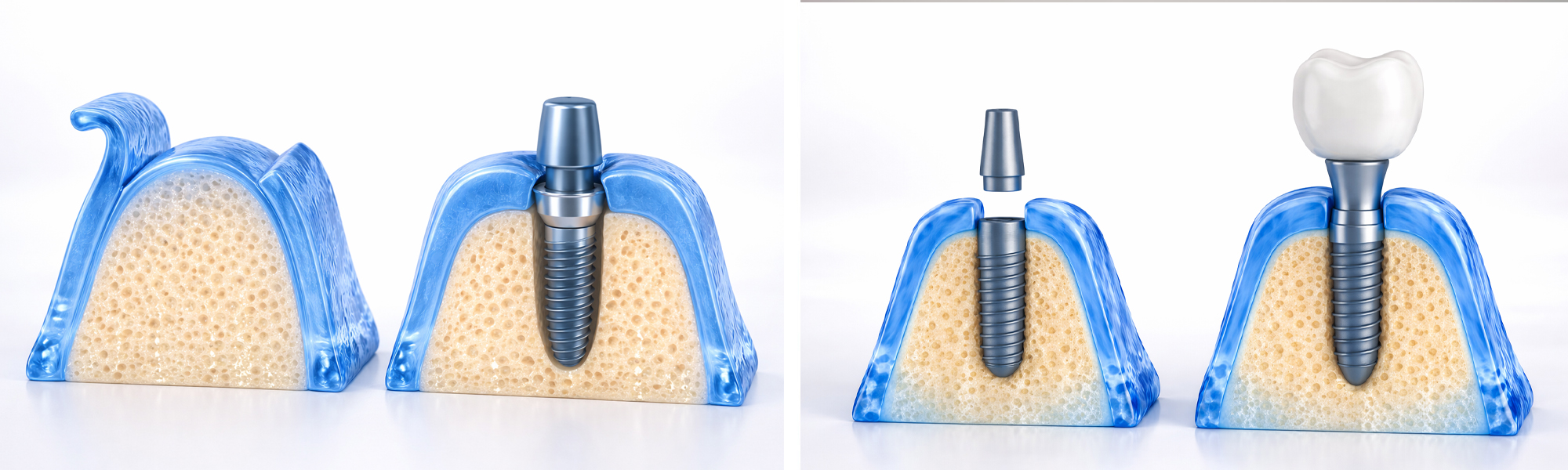 Grafikreihe zur Implantatbehandlung: Knochen, eingesetztes Implantat und endgültige Zahnkrone in drei Phasen dargestellt.