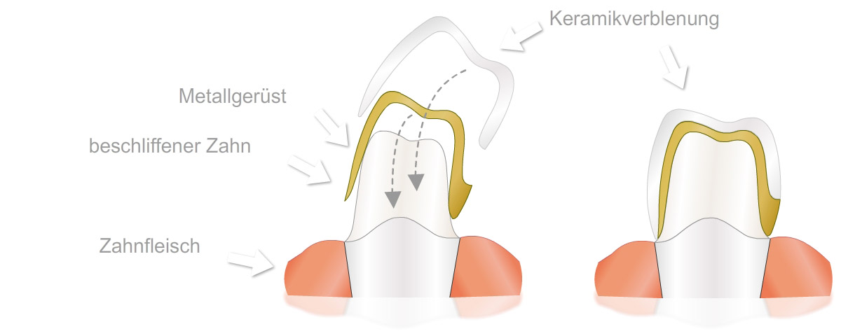 Keramik - Verblendkrone Dr. Assaf