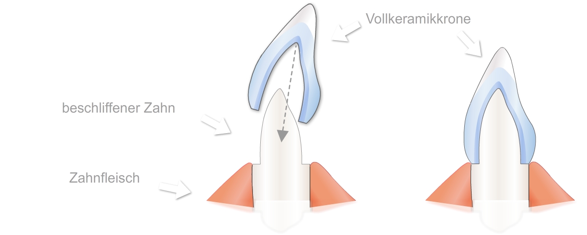 Vollkeramikkrone Dr. Assaf