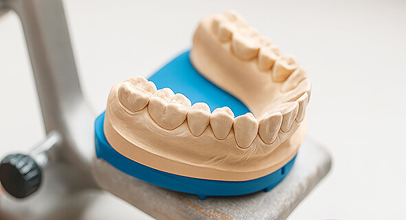 Gipsmodell eines Unterkiefers in einem Halterungsgerät, deutlich sichtbare Zähne zur Vorbereitung zahntechnischer Arbeiten.