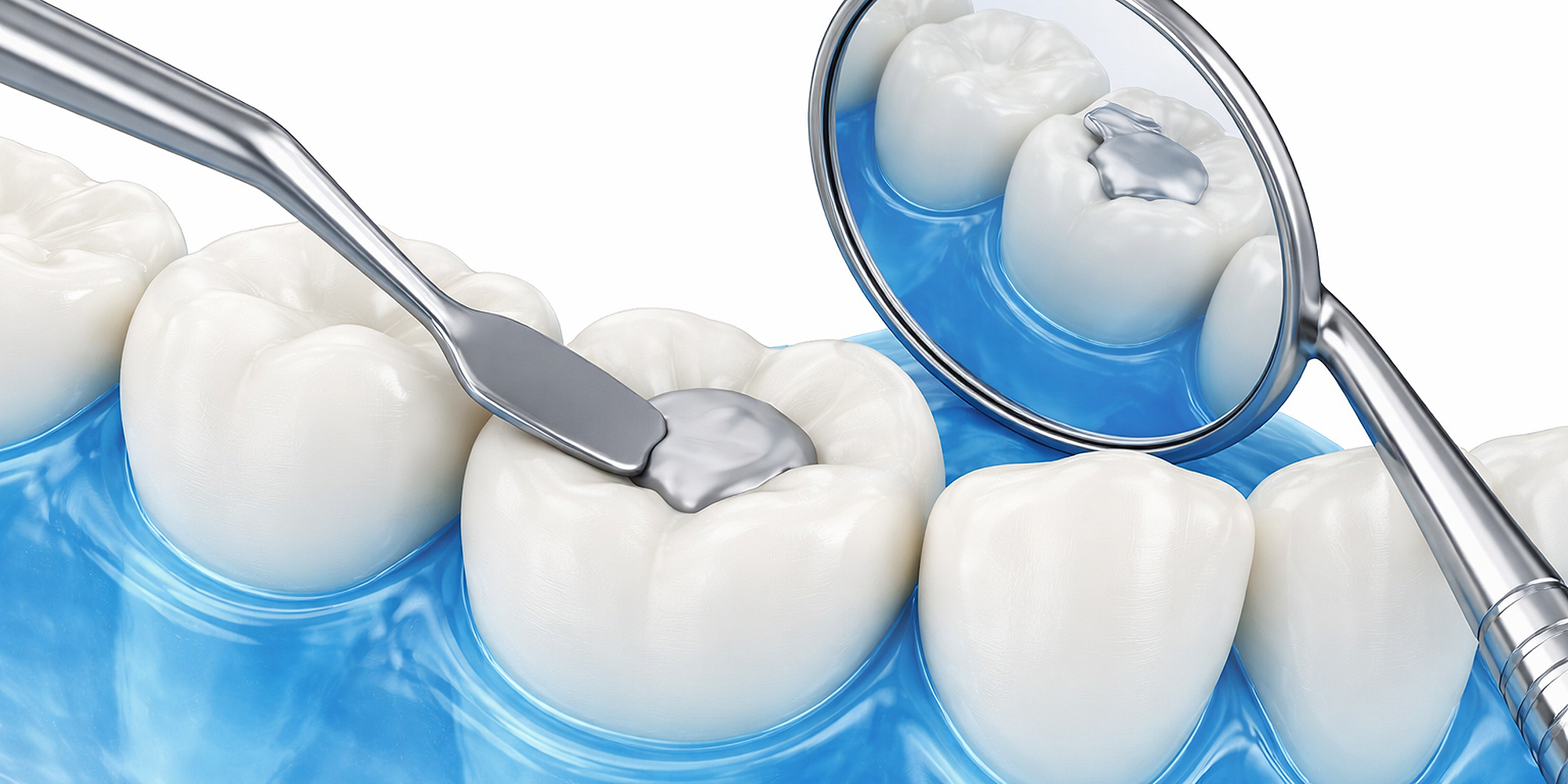 3D-Darstellung einer Zahnbehandlung mit Füllung und Spiegel – Symbol für Zahnerhaltung und ästhetische Zahnmedizin.