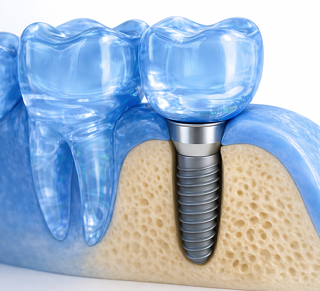 xxxxxxxGrafische Darstellung eines eingesetzten Zahnimplantats zwischen natürlichen Zähnen im Kieferknochen.