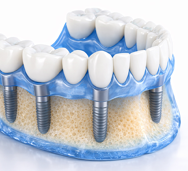 Grafische Darstellung eines Zahnbereichs mit mehreren Implantaten, die eine Brücke tragen