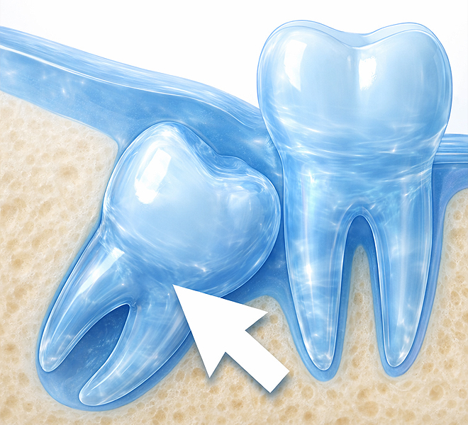 Grafisches Modell eines Zahnes mit geöffnetem Querschnitt, das den Verlauf einer Wurzelkanalbehandlung zeigt. Zahnwerkzeuge und ein Kofferdam sind daneben platziert.