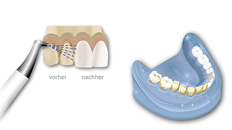 Animation Behandlung mit Airflow, bei der Zahnoberflächen schonend gereinigt werden. Vorher sind Beläge und Verfärbungen sichtbar, 
                                                                         die nach der Behandlung vollständig entfernt wurden, wodurch die Zähne sauberer und heller erscheinen.