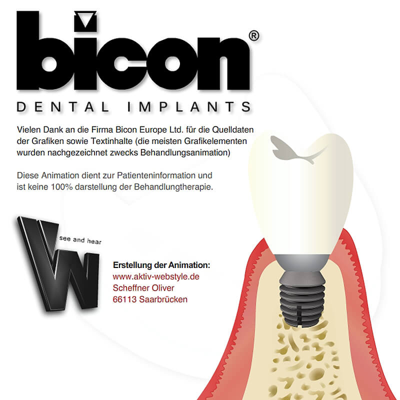 Vorschaubild - Animation einer Behandlungsmethode mit Short Implants