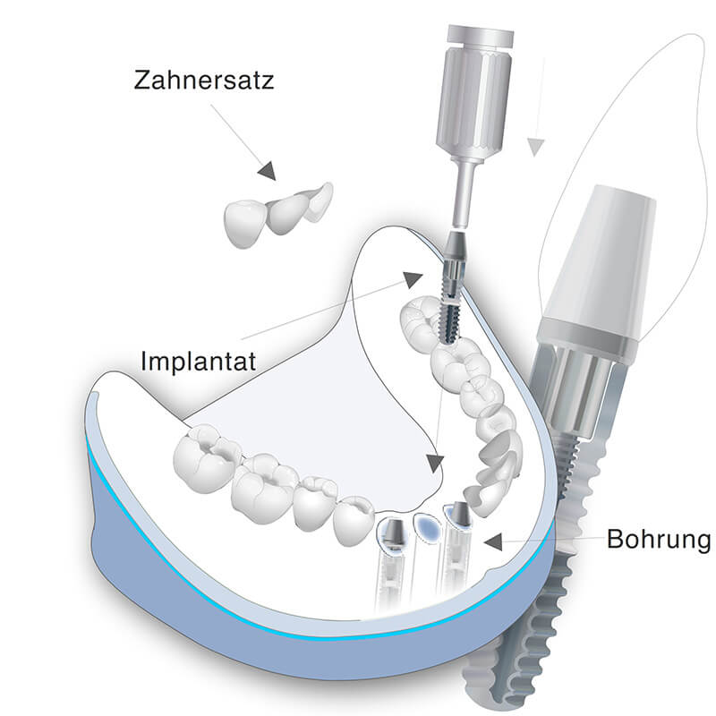 Vorschaubild - Behandlungsmethode der Schaltlücke als Illustration