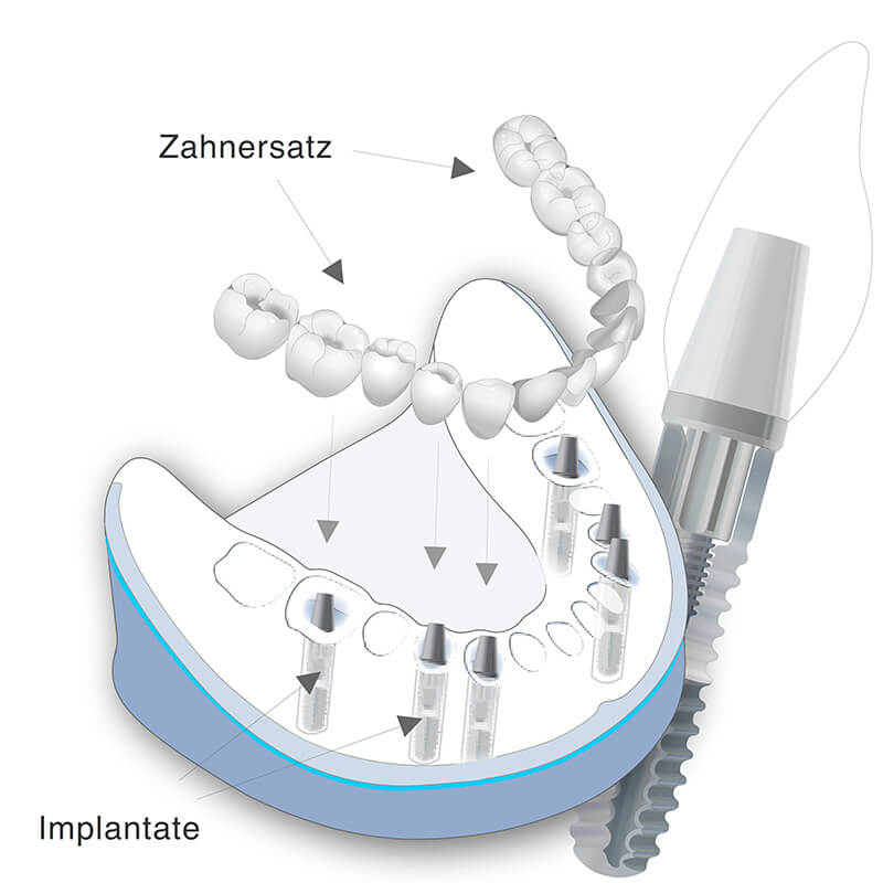 Vorschaubild - Versorgung des unbezahnten Kiefers