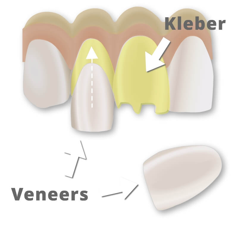 Vorschau Bild einer Behandlungsanimation von Keramik Veeners, Quer und Modellansicht