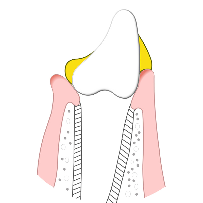 Animation zeigt Zahnbelag auf der Zahnoberfläche, der eine Entzündung des Zahnfleisches verursacht und zu Zahnfleischbluten sowie möglichen Zahnproblemen führen kann.