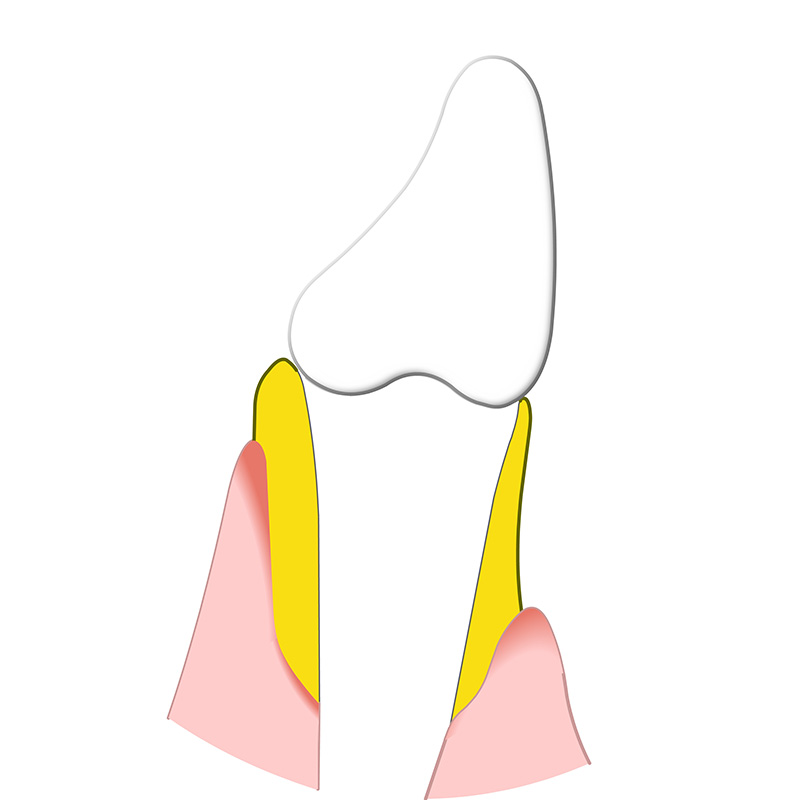Animation, Auswirkungen von unbehandelter Parodontitis, die zum Abbau von Zahnfleisch und Kieferknochen führt und letztlich Zahnausfall verursachen kann.