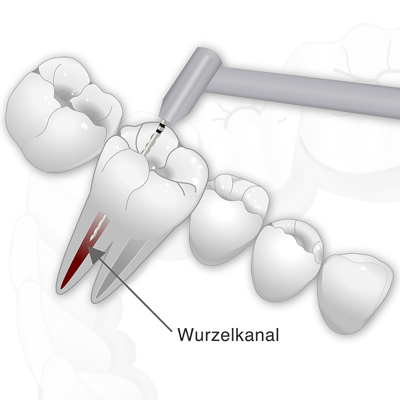 Vorschaubild - Behandlungsablaufes einer Wurzelbehandlung