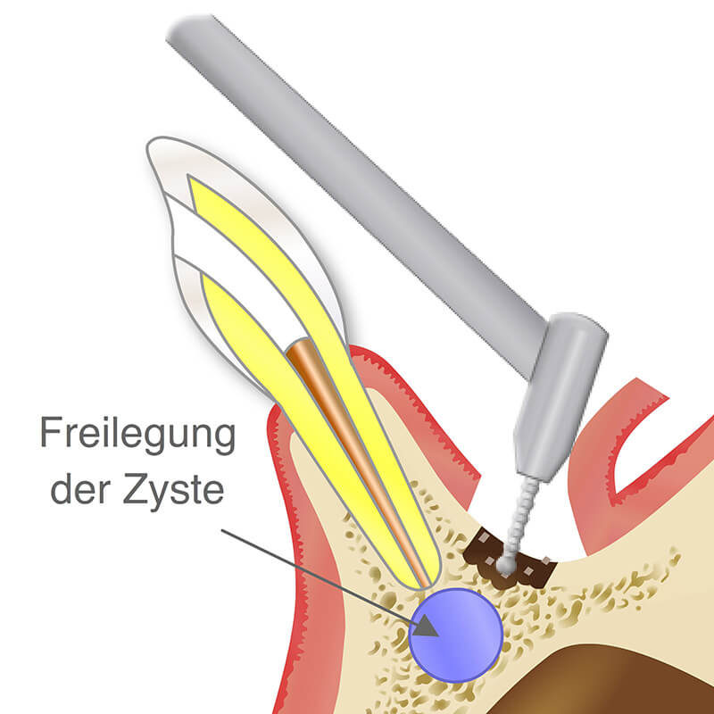 Illustration Vorschaubild - Animation einer Zystenentfernung